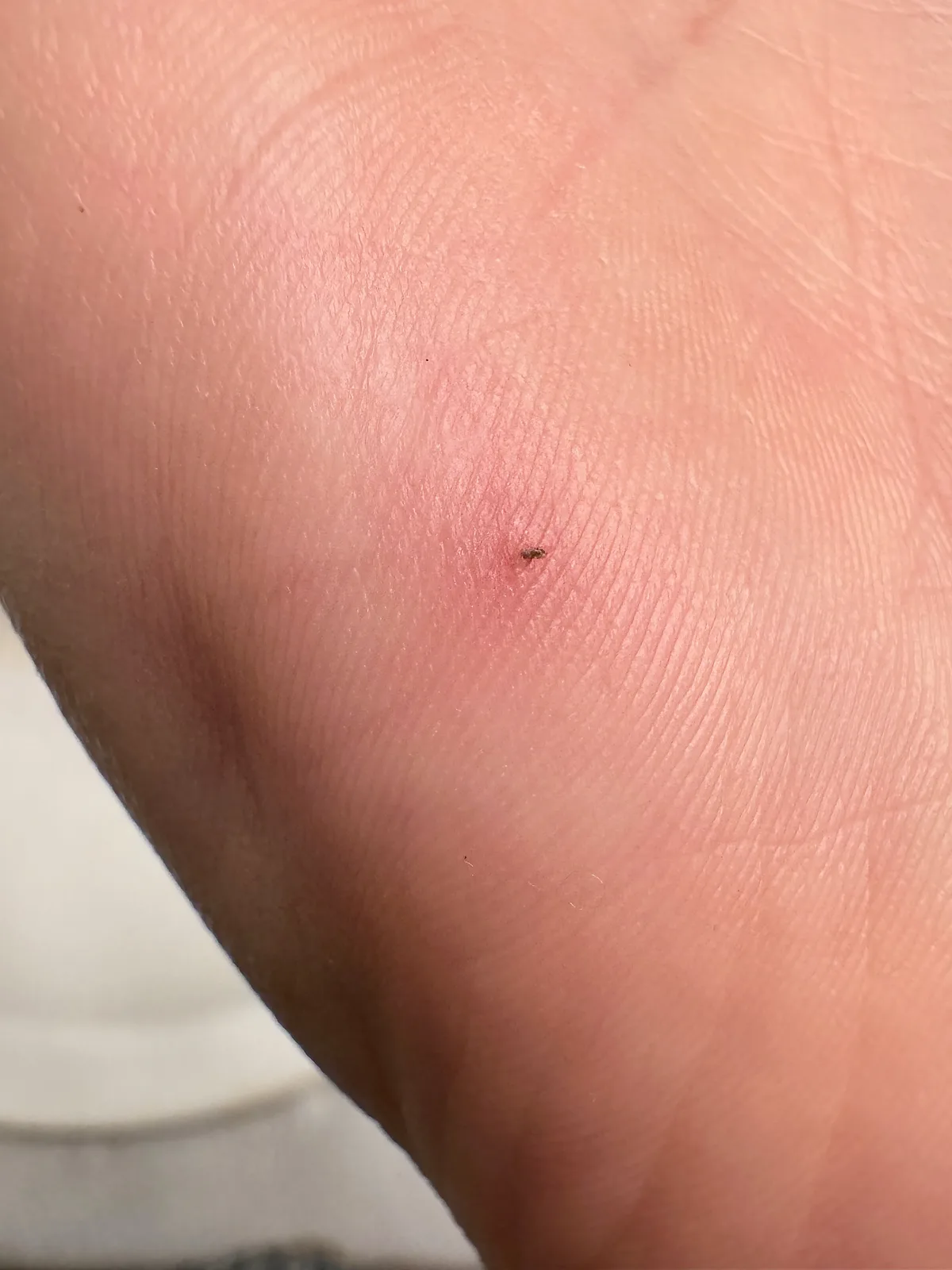 Close-up van een hand met letsel — illustratie bij persoonlijke ongevallenverzekering voor zzp'ers