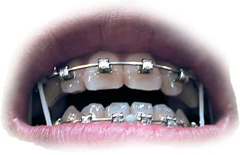 Close-up van tanden met vaste orthodontische beugel — tandartsverzekering voor kinderen en orthodontie 2026